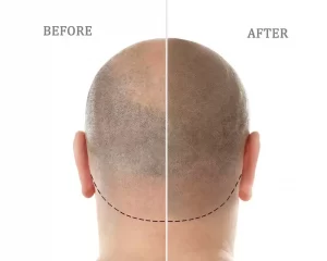 Micro Scalp Pigmentatie