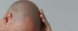 Micro Scalp Pigmentatie Amsterdam