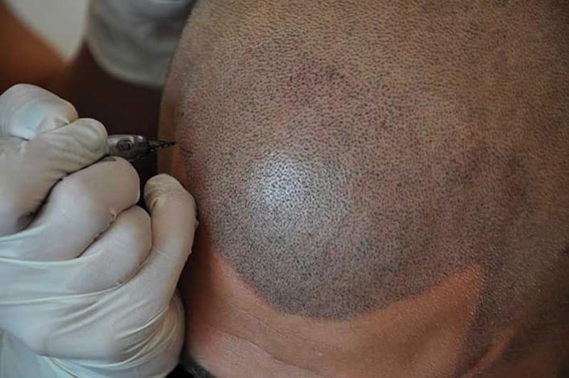 Micro Haar Pigmentatie Amsterdam