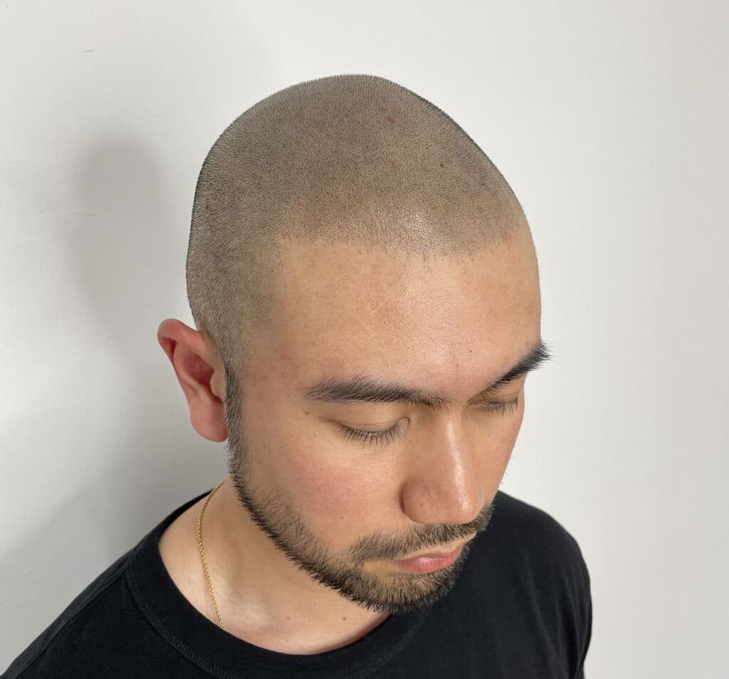 Micro haar pigmentatie Amsterdam