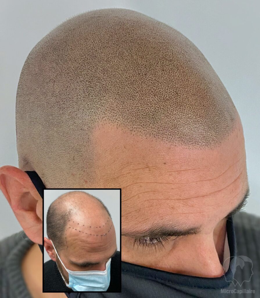Micro Haar Pigmentatie Amsterdam
