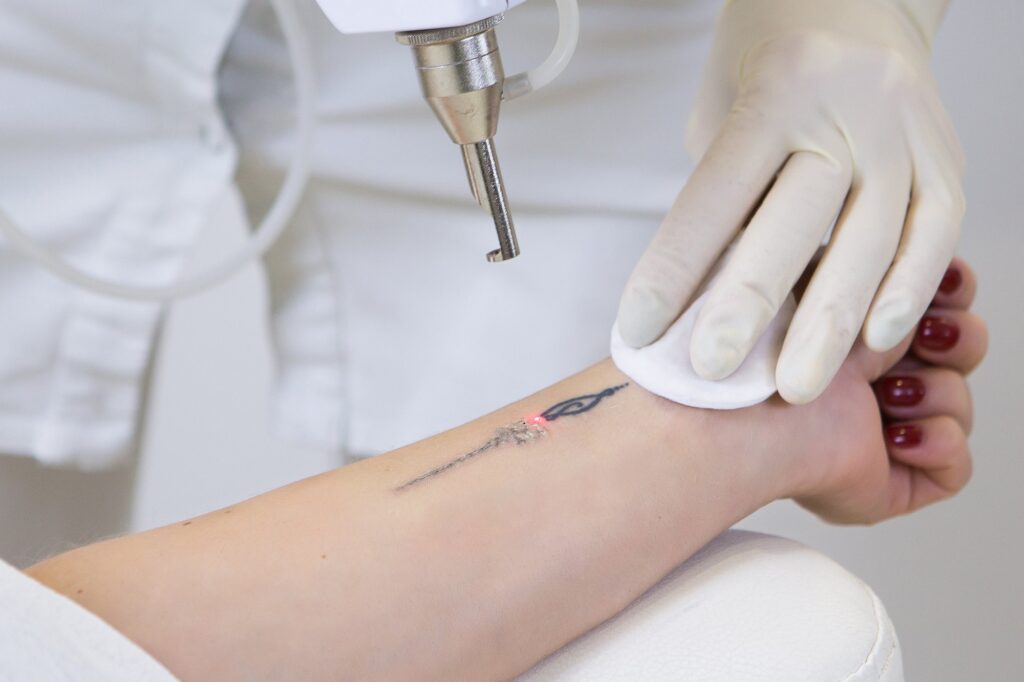 Tattoo verwijderen Rotterdam en Amsterdam