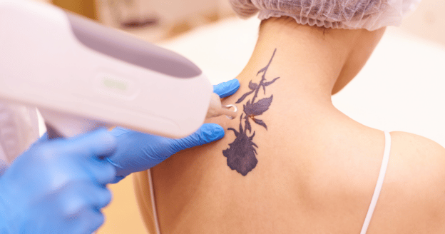 Tattoo verwijderen Rotterdam en Amsterdam