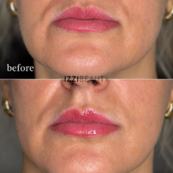 Lip Booster Treatment before & After - Online Training including Certificate